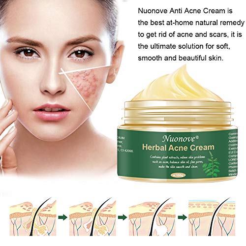 Crema Antiacne, Acné Crema, Acne Tratamiento, Reducir los Puntos negros, Acne Cream, Equilibrar el Agua y el Aceite, la Crema Contra el Acné Espinilla Regenera la piel, 100 g