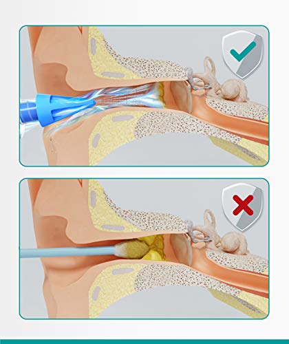 Medi Grade Kit de Jeringuilla para Limpieza de Oídos y 3x Puntas Suaves para Sacar Cera - Limpiador de Oidos Reutilizable - Mejora la Audición y la Salud del Oido - Jeringa Oidos Casero