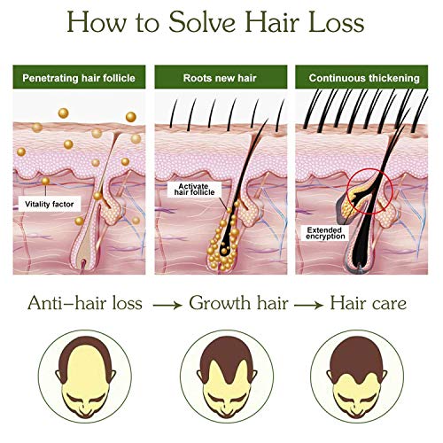 Sérum de crecimiento del cabello,crece pelo,antipérdida de cabello, para acelerar el crecimiento del cabello, promueve más cabello ticker, más completo y más rápido crecimiento-30ML