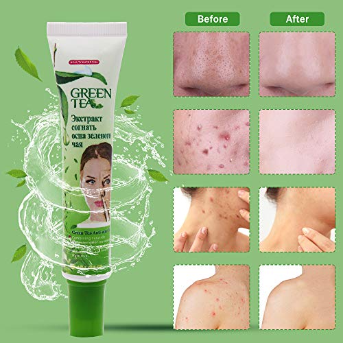 Crema Antiacne, Anti Acne, Acne Tratamiento, Acné Crema, Balance Facial Agua Y Aceite, Acné Reparador De Fosas, Crema Anti-Acné Acné Para Regenerar La Piel