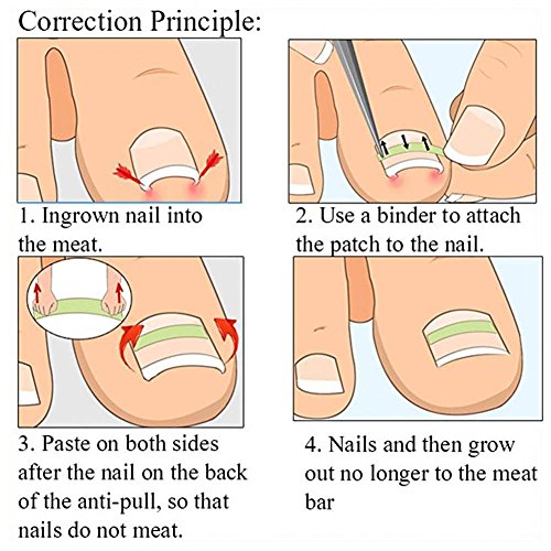 Herramienta Corrector de uñas 6 en 1 Kit Reparador de uñas con uñas encarnadas Pedicura Herramienta recuperadora de uñas Recuadro de uñas Kit de cuidado de pies(#1)