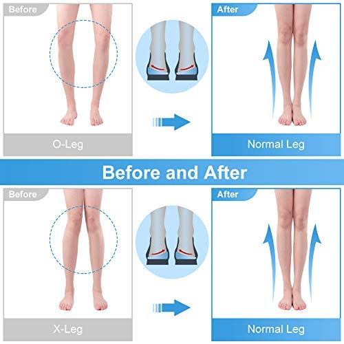 DOACT Plantilla ortopédica corrección piernas en forma 2 pares, elevación cuña del talón para piernas tipo O/X, almohadilla de gel silicona para la corrección la pierna, supinación y pronación S