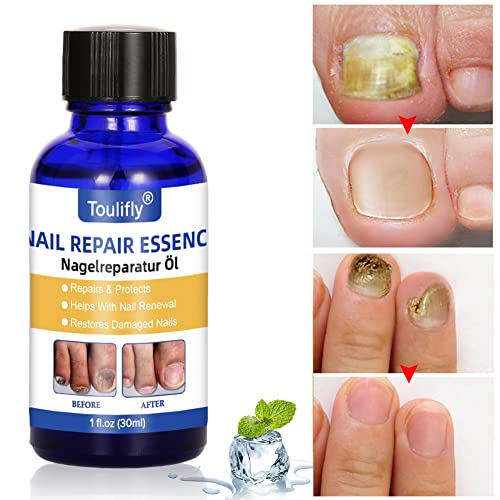 Solución de uñas micóticas, Tratamiento de Uñas de los hongos, Apto para dedos y pedicura, Solución de uñas de Hongos para uñas descoloridas, Gruesas, desmenuzadas y con Hongos